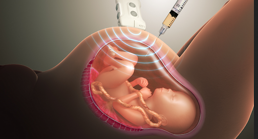 Down Syndrome Diagnostic Tests