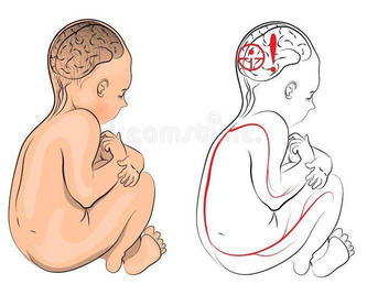 What is Cerebral Palsy