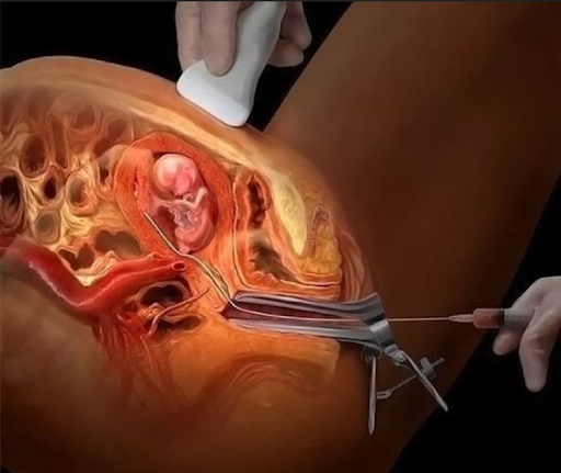 Chorionic Villus Sampling