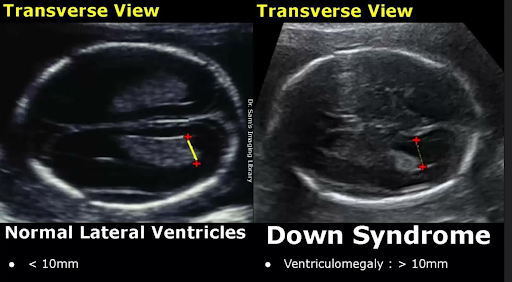 Down Syndrome - Prenatal Tests