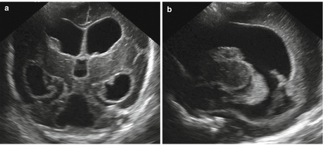 Ultrasound