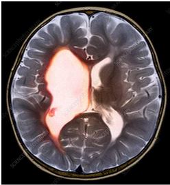 MRI