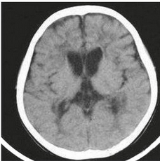CT Scan