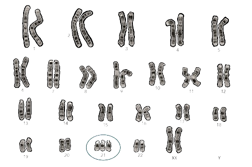 Trisomy 21
