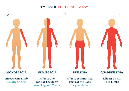 types of Cerebral Palsy