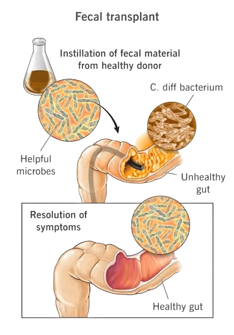 Faecal Microbiota Transplantation