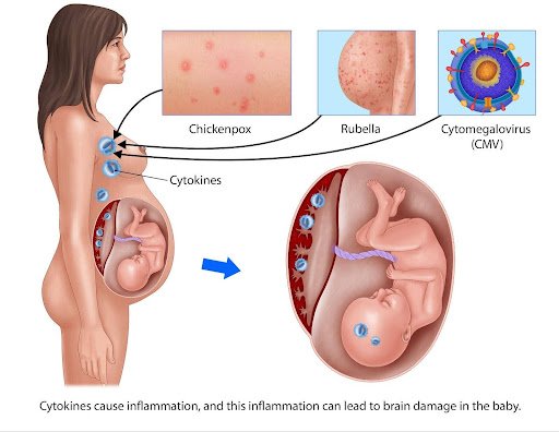 maternal infections can lead to inflammation and potential brain damage